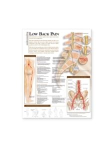 Understanding Low Back Pain Anatomical Chart - 9780781782425