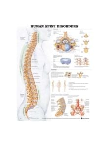 Human Spine Disorders Anatomical Chart - 9781587794438